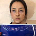 Injeksi Pengisi Cetakan Jahitan Kosmetik PDO Mono Cog Thread Face Lift